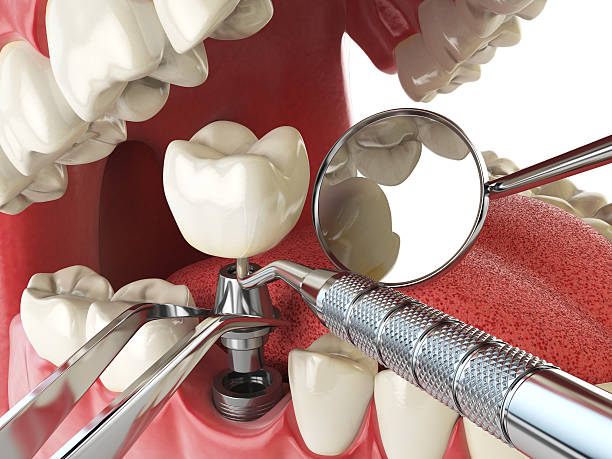 Best Emergency Treatment for Dental Infections or Abscesses in Eatonville, FL